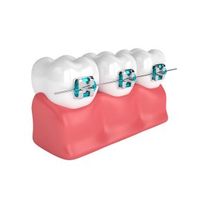 Dental Braces